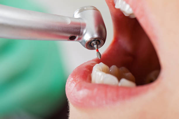 Best Urgent Dental Care for Toothache in Bel Air North, MD